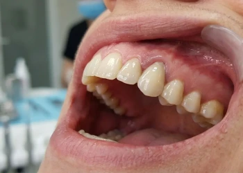 Geçici Diş Nedir? Nasıl Takılır ve Takılmazsa Ne Olur?