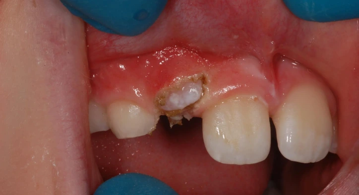 Embedded Canine Tooth Guide: Surgery, Extraction and Braces Process