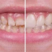 What Is Pink Aesthetics? Gum Aesthetics Prices and Procedures