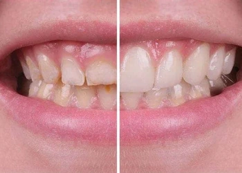 Was Ist Pink Aesthetics? Zahnfleischästhetik Preise und Verfahren