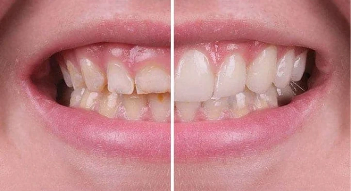 Was Ist Pink Aesthetics? Zahnfleischästhetik Preise und Verfahren