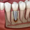 Periimplantitis Nedir? Belirtileri, Lazer ve Antibiyotik Tedavisi