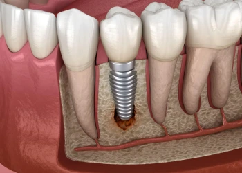 Was ist Periimplantitis? Symptome sowie Laser- und Antibiotikabehandlung