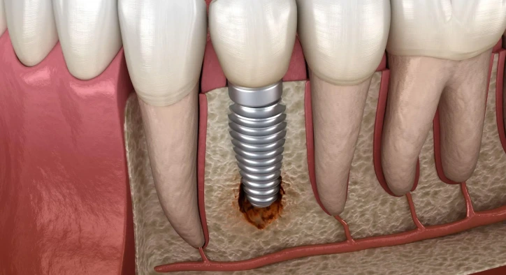 Was ist Periimplantitis? Symptome sowie Laser- und Antibiotikabehandlung