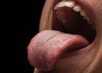 What Is Burning Mouth Syndrome? Symptoms, Causes and Treatment