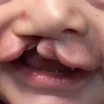 What Is a Cleft Palate? Causes, Surgery and Treatment