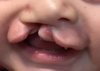 Was ist eine Gaumenspalte? Ursachen, Operation und Behandlung