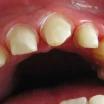 What Is Tooth Preparation? How Is It Done? Pain and the Process