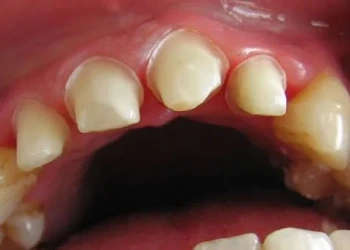 What Is Tooth Preparation? How Is It Done? Pain and the Process