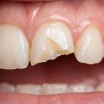 What Causes a Tooth to Break? Does It Cause Pain and How Is It Treated?