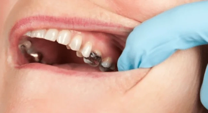 What Is a Lost Filling? Causes, Symptoms and Emergency Action