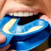 Florür Tedavisi Nedir? Nasıl Yapılır, Çürük Önleme ve Fiyatları
