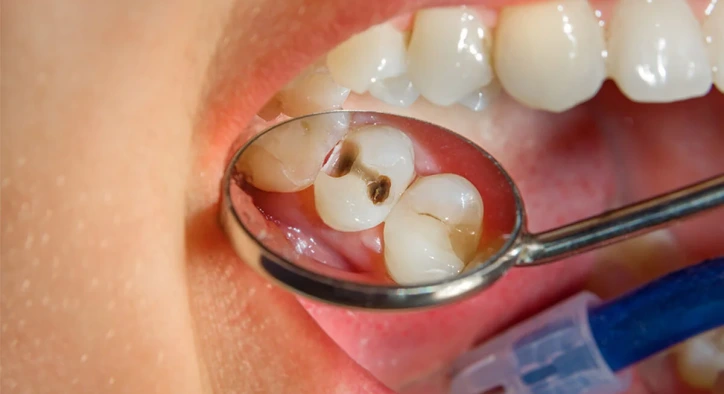 Can Root Canal Treatment Be Completed in a Single Session? How Is It Done?