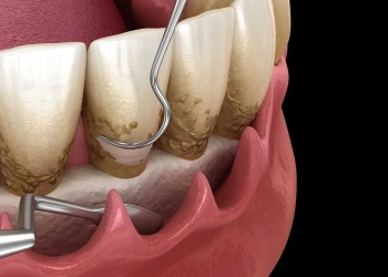 Diş Küretaj Nedir? Nasıl Yapılır, Ağrılı mı?