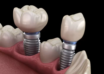 What Is a Titanium Implant? Costs, Allergy Risk, and Procedure