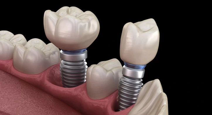 Titanyum İmplant Nedir? Fiyatları, Alerji Riski ve Yapılışı