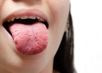 What Is Geographic Tongue? Symptoms, Causes, and Treatment