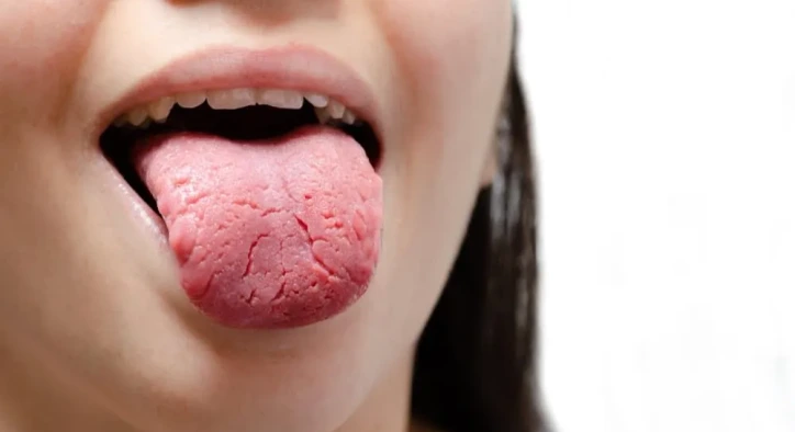 What Is Geographic Tongue? Symptoms, Causes, and Treatment