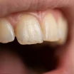 Was ist Zahnabrasion? Ursachen, Symptome und Behandlung