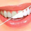 Ist Zahnbleaching dauerhaft? Haltbarkeit, Rückfall & Tipps