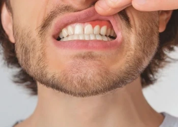 What Is Gum Peeling? Procedure, Laser Treatment, and Costs