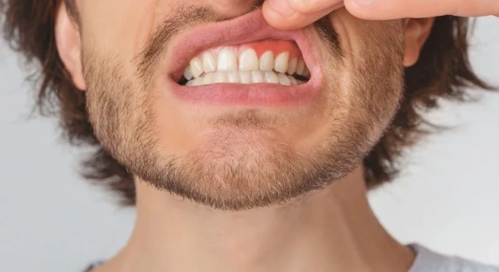 Was ist ein Zahnfleisch-Peeling? Ablauf, Laserbehandlung und Preise