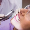 Does Tartar Removal Thin the Teeth? Is It Harmful or Painful?