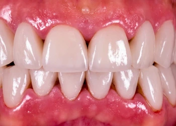 What Is a Black Triangle Between Teeth? Causes and Treatment