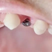 Implantatschraube sichtbar: Ursachen, Zahnfleischrückgang & OP