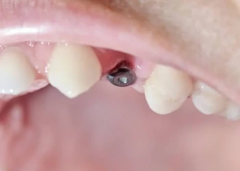 Implantatschraube sichtbar: Ursachen, Zahnfleischrückgang & OP