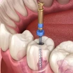 Was ist eine Wurzelkanalrevision (Retreatment)? Wie wird sie durchgeführt?