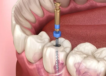 Kanal Tedavisi Yenileme (Retreatment) Nedir? Nasıl Yapılır?