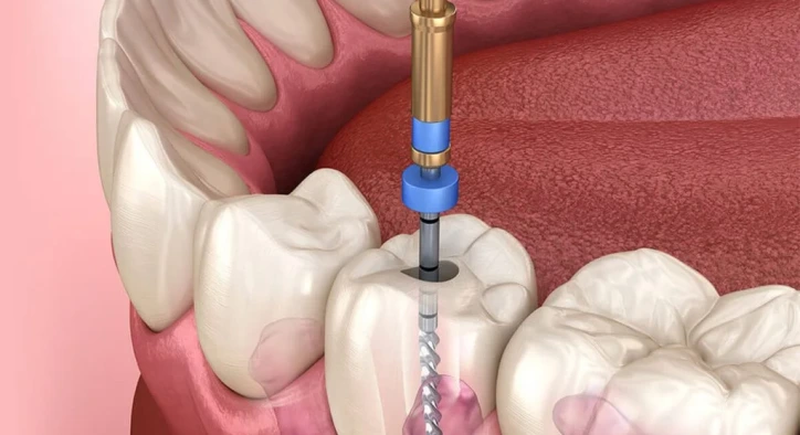 Kanal Tedavisi Yenileme (Retreatment) Nedir? Nasıl Yapılır?