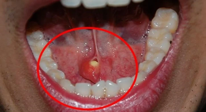 What Is a Salivary Gland Stone? Symptoms and Treatment Methods