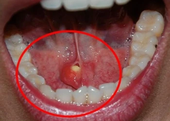 Tükürük Bezi Taşı Nedir? Belirtileri ve Tedavi Yöntemleri